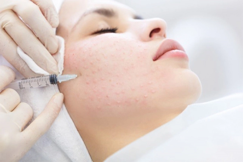 Trend of skin rejuvenation with Mesotherapy 
