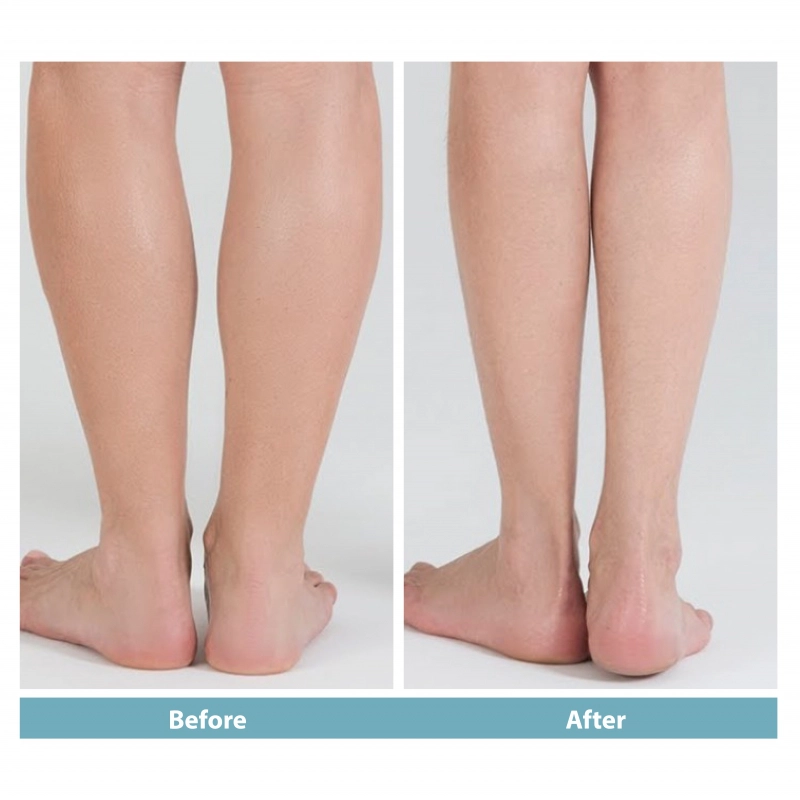 Botox body