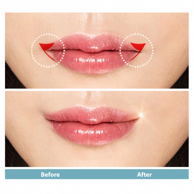 Botox for creating smiling lips