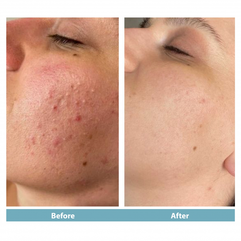 Microneedling