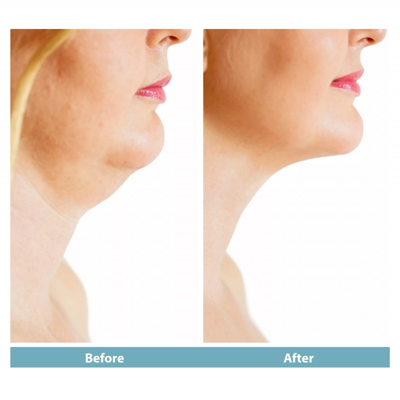 Fat dissolving injection cheeks/double chin