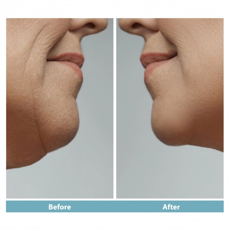 Botox Dimpled Chin
