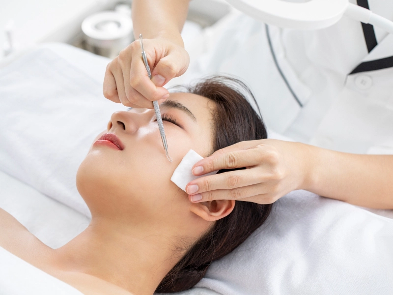 Acnes extraction