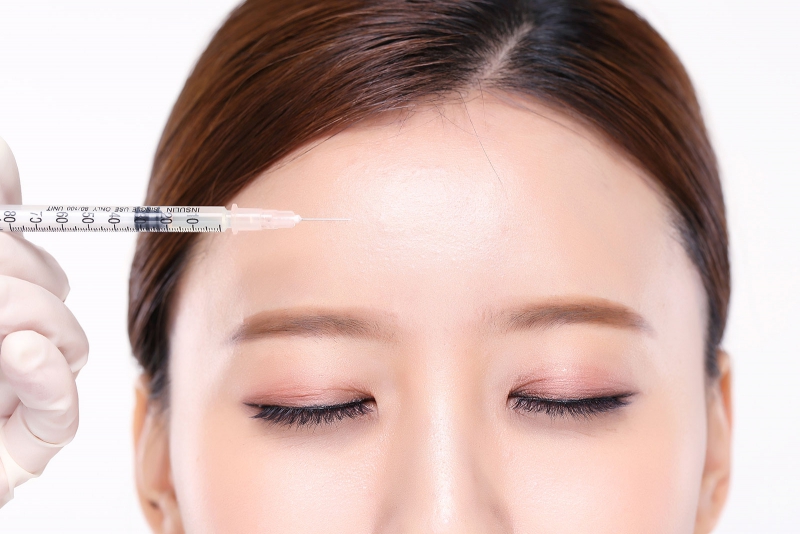 Giải pháp tiêm botox xóa nhăn trán cho làn da mịn màng