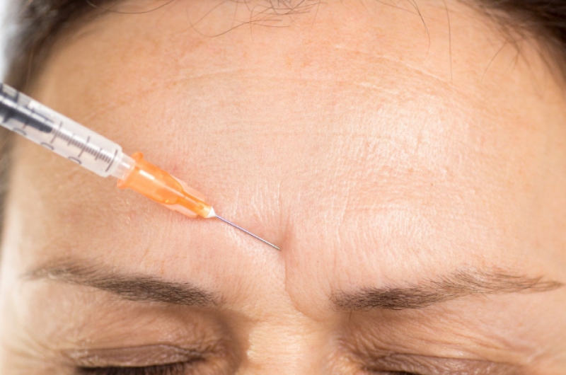 Công nghệ tiêm Botox xóa nhăn cau mày giúp loại bỏ dấu hiệu lão hóa