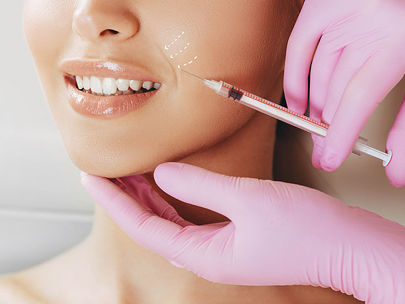 Liệu trình tiêm filler làm đầy rãnh cười xóa nếp nhăn hiệu quả