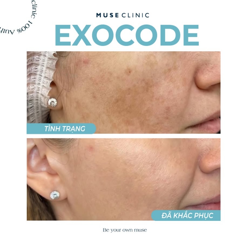 Exocode Plus