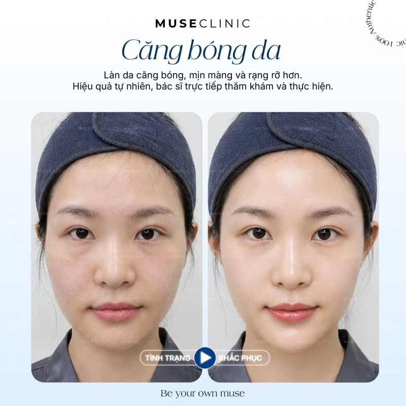 Restylane