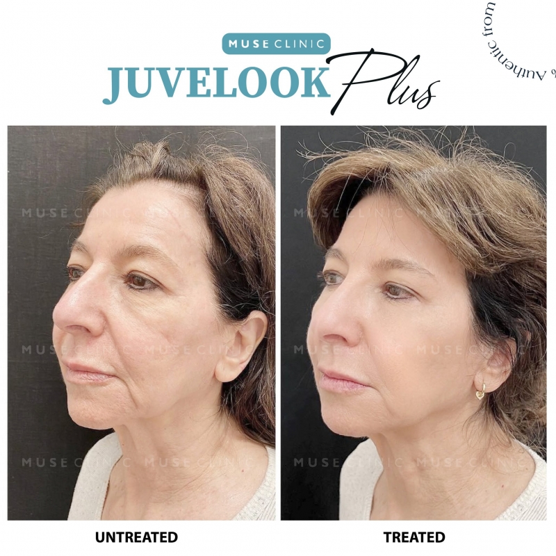 Juvelook