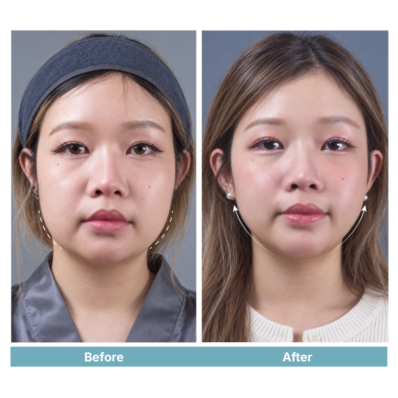 MULTI-LAYER LIFT PRO