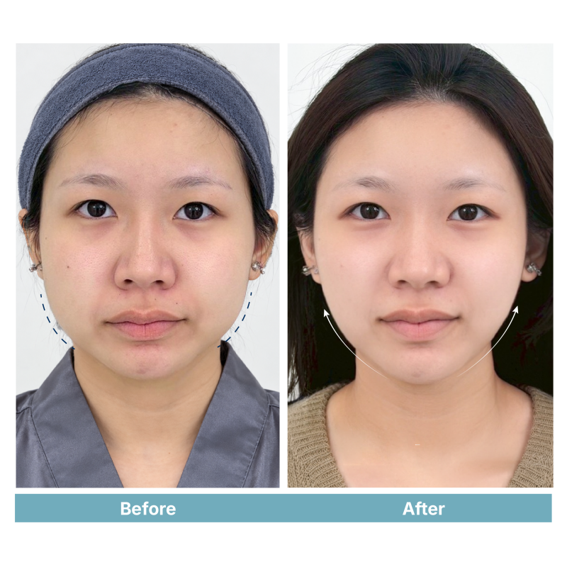 MULTI-LAYER LIFT